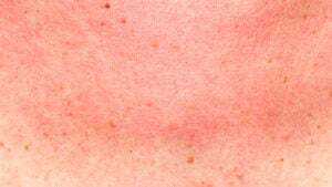 Subside Redness Skin Redness: Causes, Other Symptoms, and Treatments