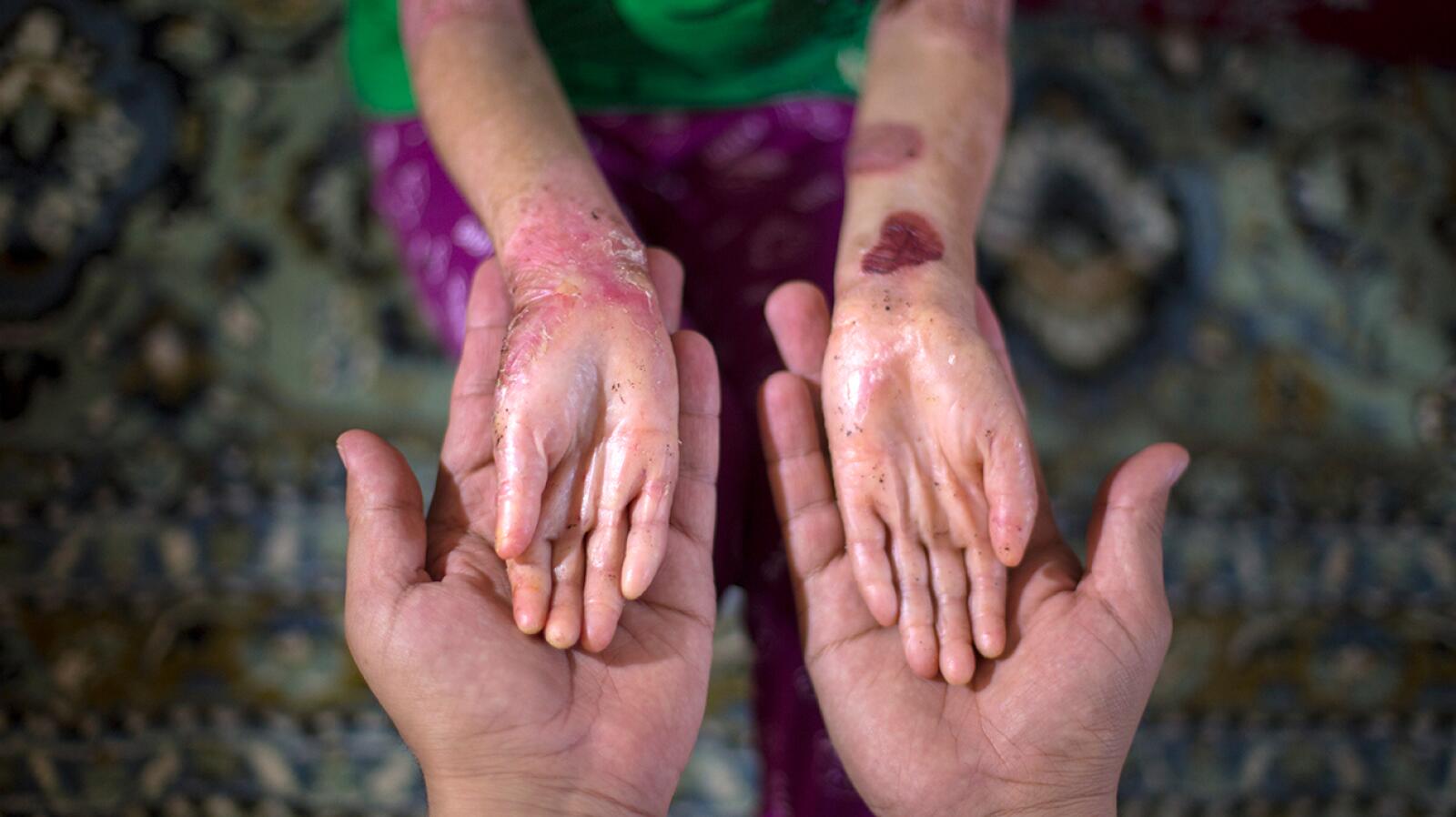 Epidermolysis Bullosa: Symptoms, Causes, and Treatments