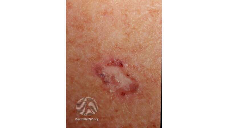 A medical image of amelanotic melanoma.
