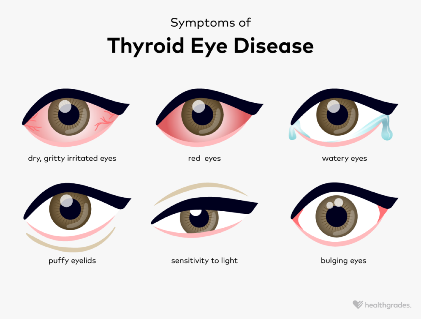 Thyroid Eye Disease: Definition, Symptoms, Causes, and More
