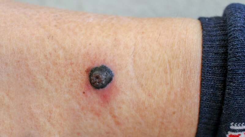 A medical image of nodular melanoma.