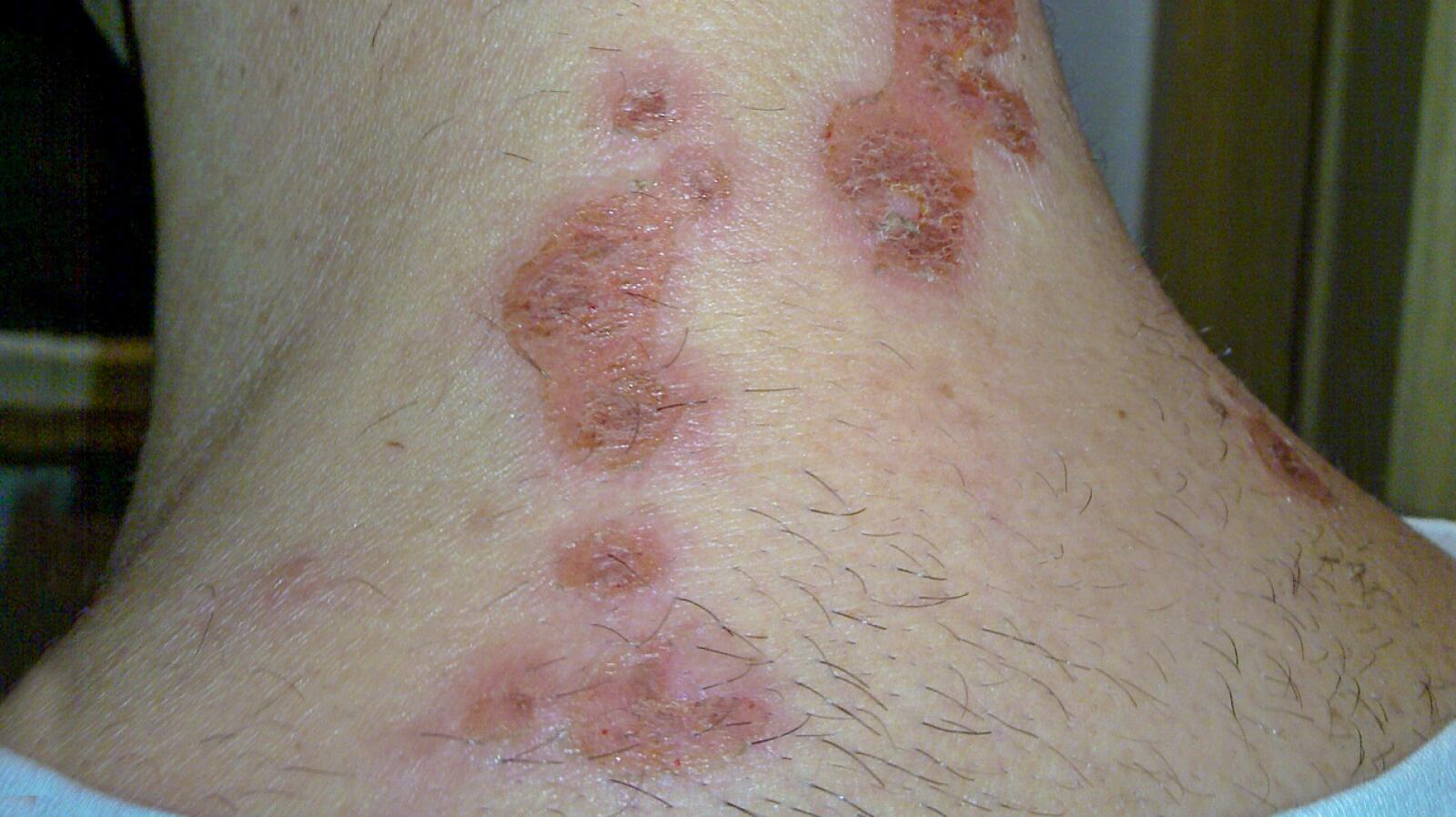 Types of Staph Infections Symptoms, Causes, and Treatments