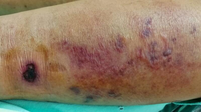 Image of necrosis on a leg