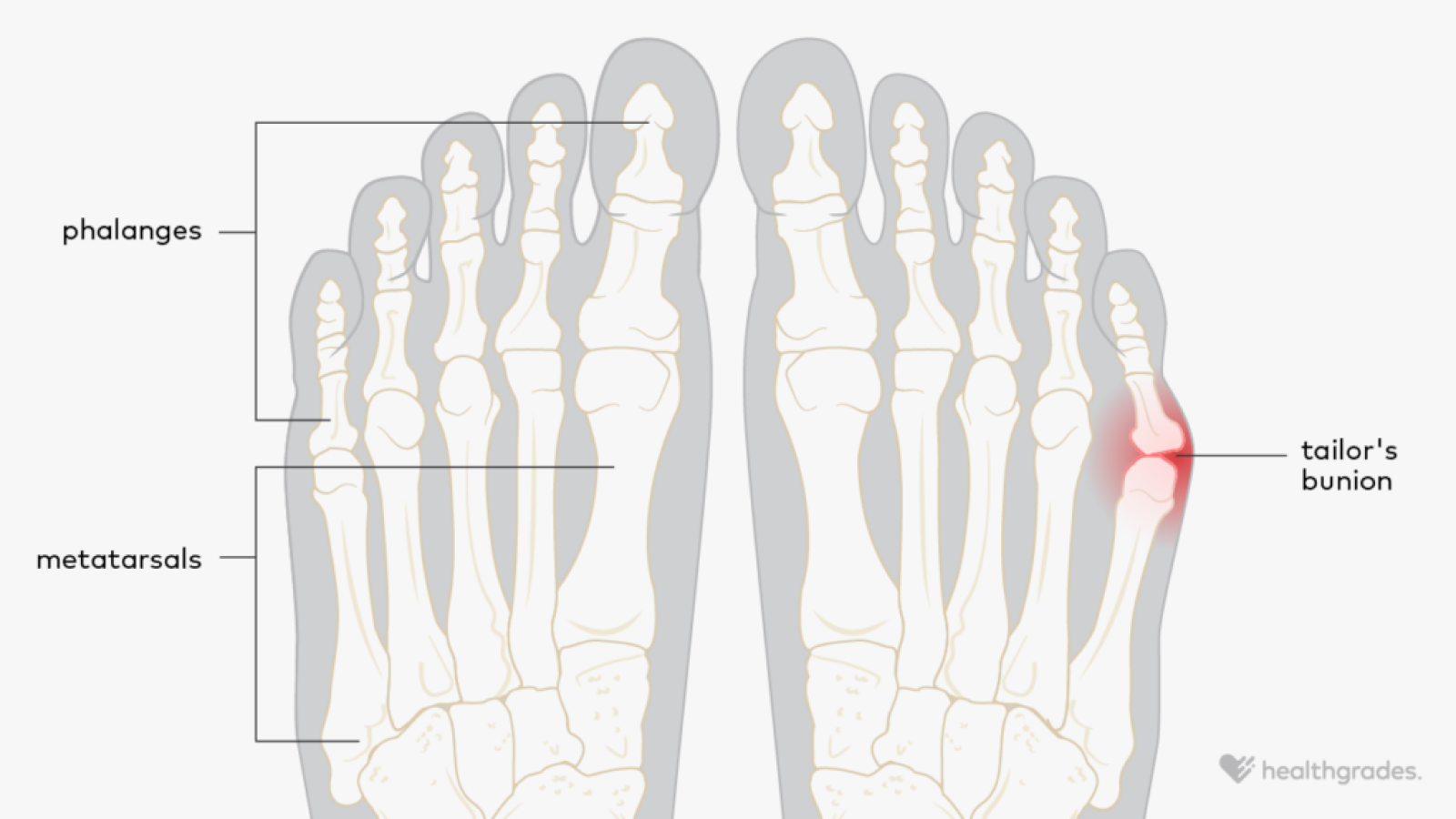 Tailor’s Bunion: Symptoms, Causes, Treatments, and More
