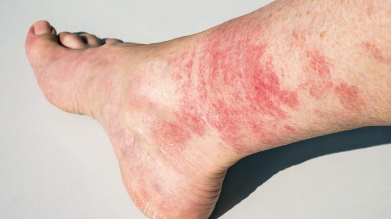 Rash On Legs Causes And Treatment