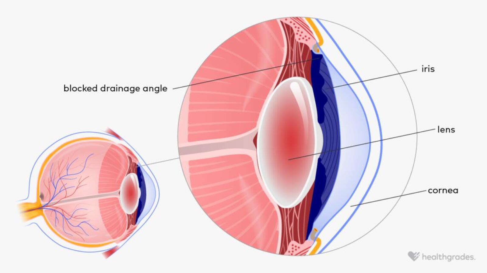 Narrow Angle Glaucoma Symptoms Causes And Treatment narrow-angle-glaucoma-symptoms-causes-and-treatment