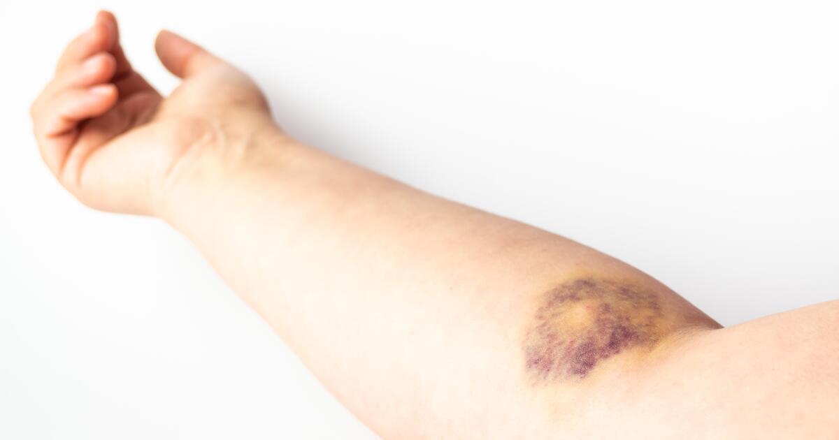 Hematoma Symptoms Causes Treatments