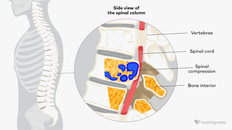 Spinal cord compression