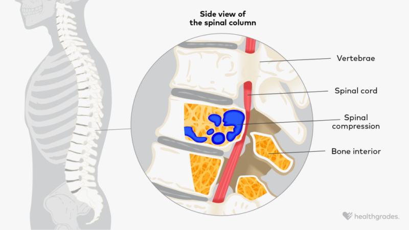 Spinal Cord Compression