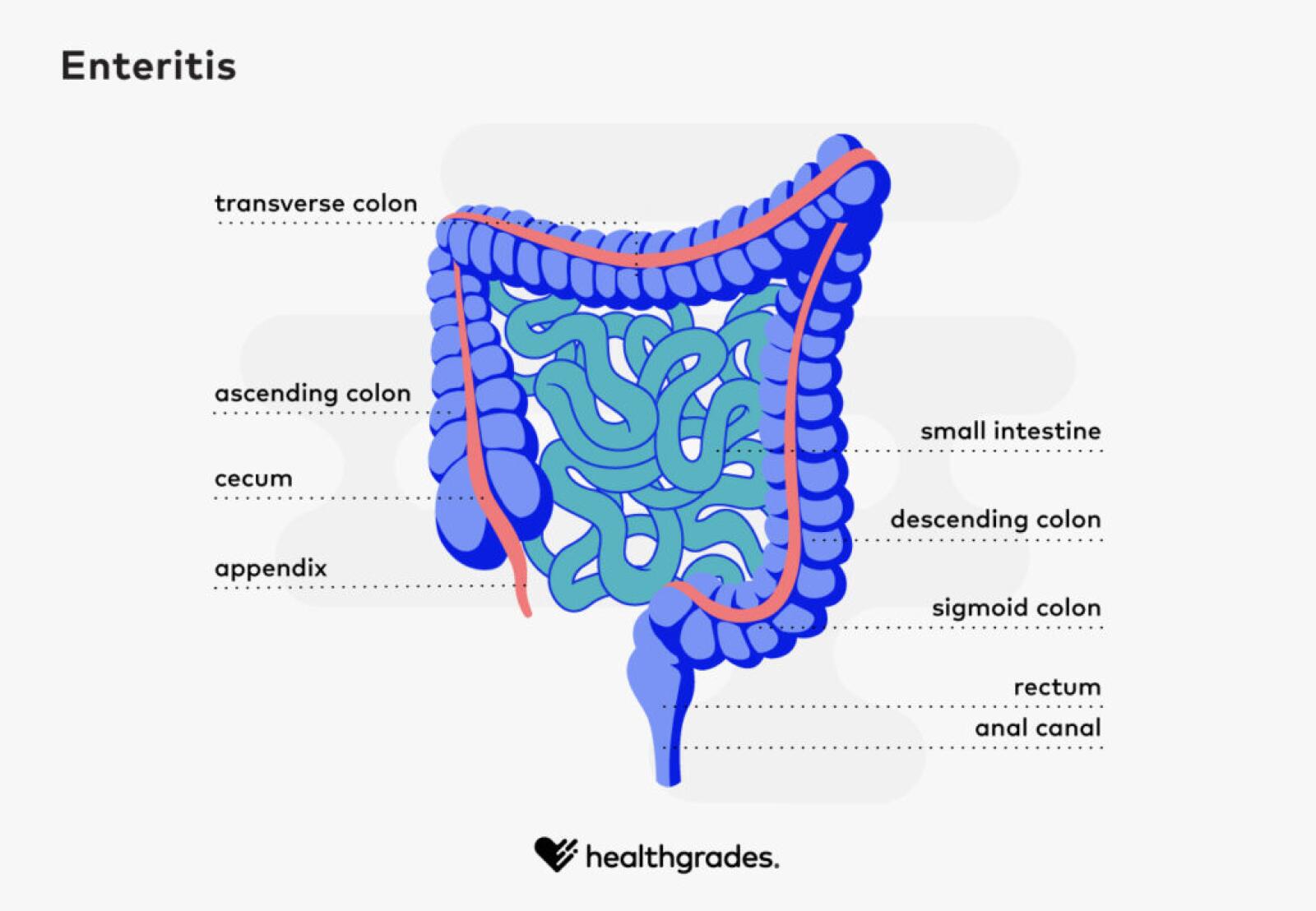 Enteritis Symptoms, Causes, Tests, and Treatments