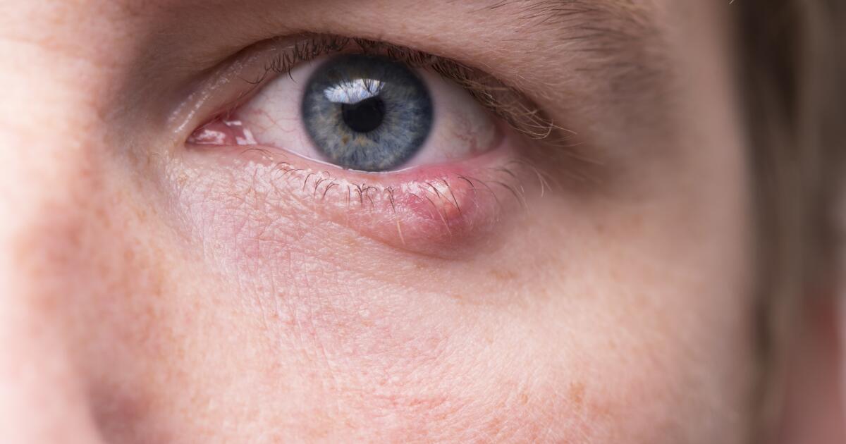 stye treatment when to see a doctor for a stye in the eye eyelid