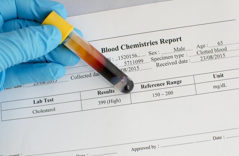 foods high in cholesterol high cholesterol foods to avoid