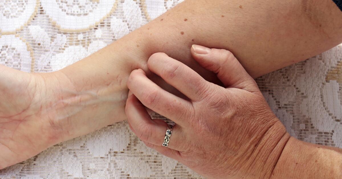 Hepatitis B Rashes Hepatitis B Yellow Skin