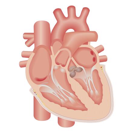With aortic stenosis, the opening in the heart's aortic valve becomes narrow. This decreases the amount of blood that can flow to your body. Here are eight things you should know about this serious heart condition.
