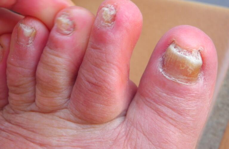 Toenail Fungus Causes Treatments Symptoms And More 