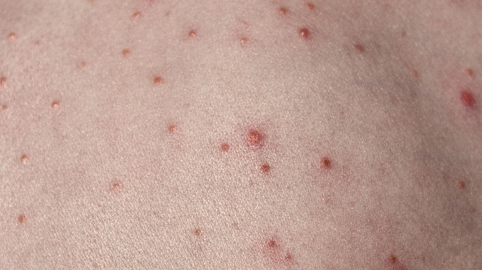 Chlorine Rash Pictures, Causes, Symptoms, Treatments