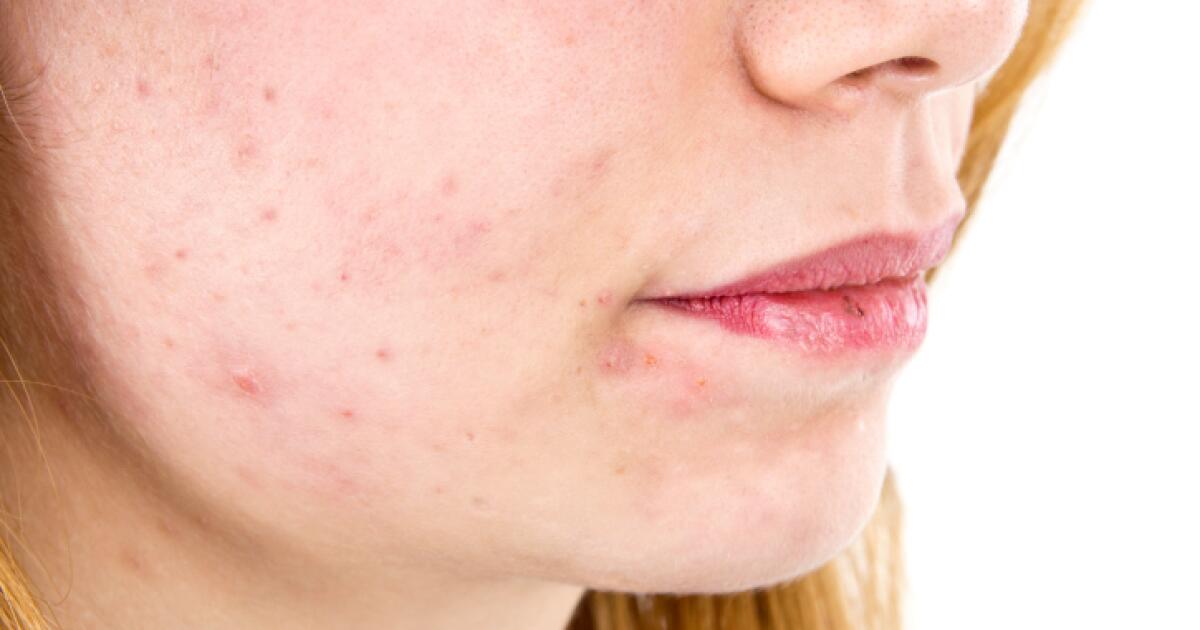 bacterial rash on face