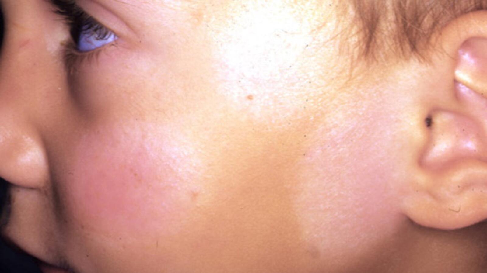 Treating Hypopigmentation Causes, Remedies, and More