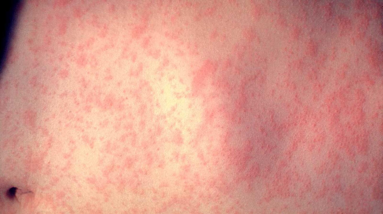 Rash on Stomach: Causes, Symptoms, and Treatment