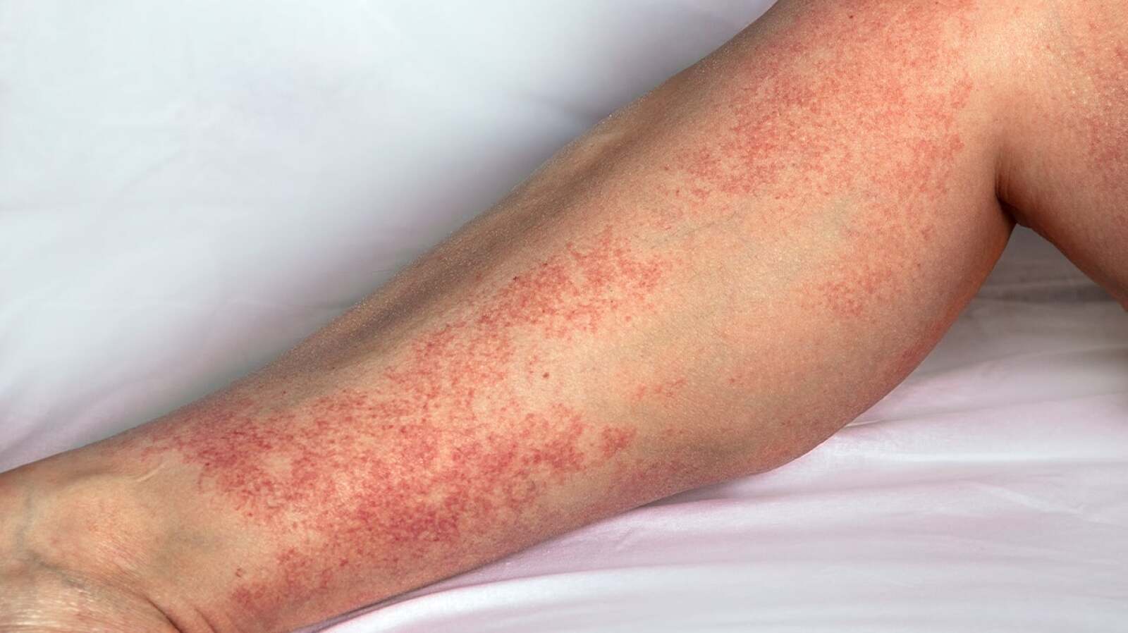 Dermatitis Examples Atopic Dermatitis vs. Contact Dermatitis: What's the Difference?