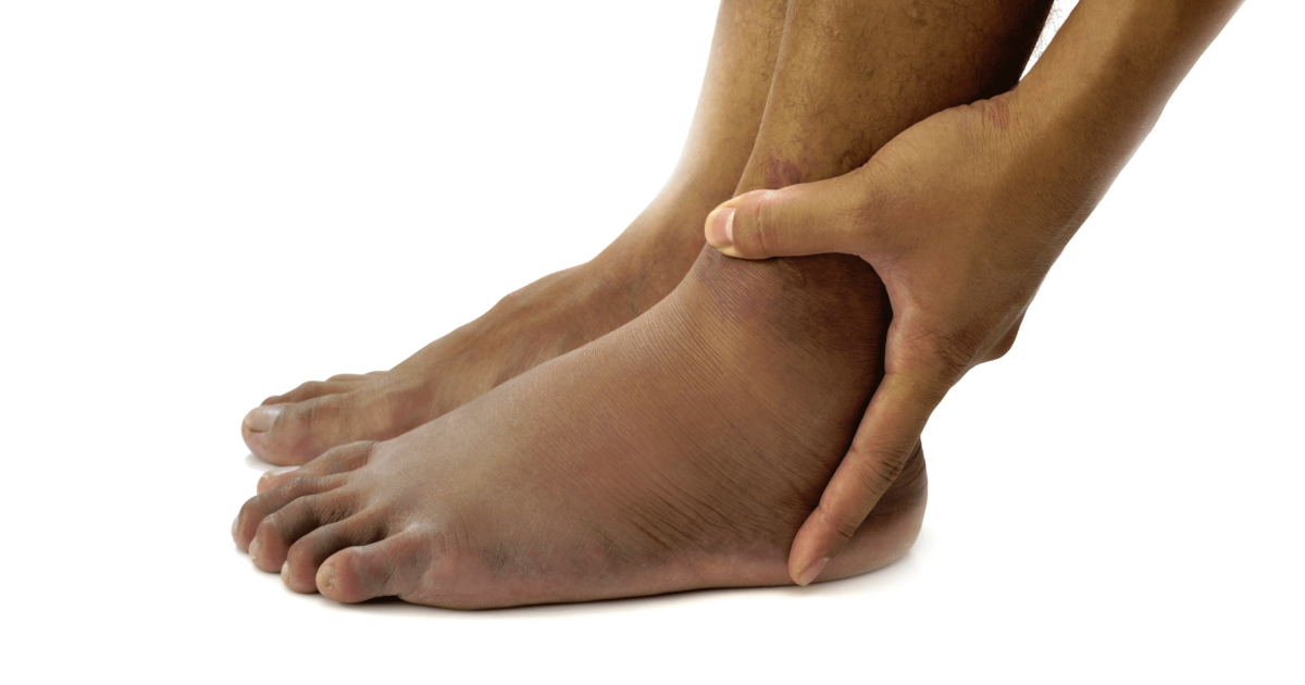 Managing Swollen Feet Ankles Caused By Heart Failure