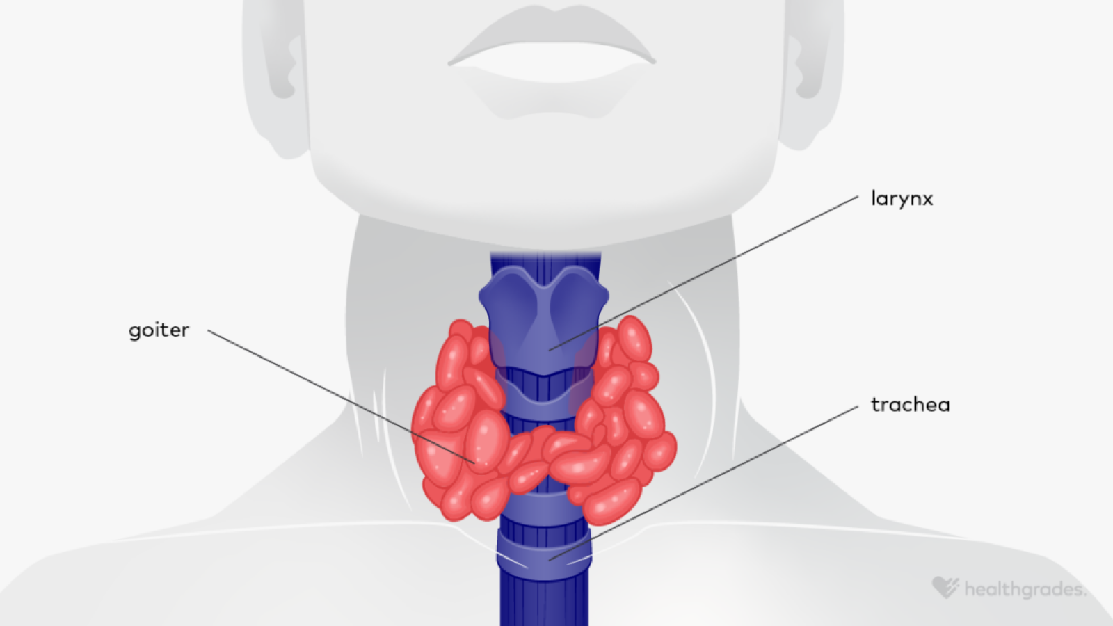 Enlarged Thyroid: Causes, Symptoms, and Treatment of Goiter