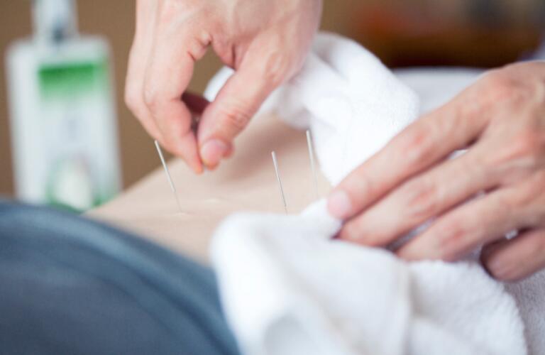 Acupuncture