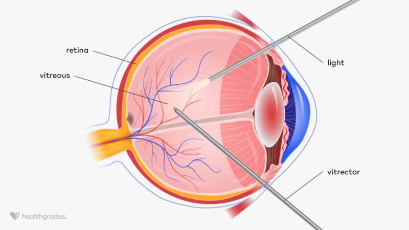 What Is Vitrectomy Procedure Outlook And Risks What Is Vitrectomy Procedure Outlook And Risks