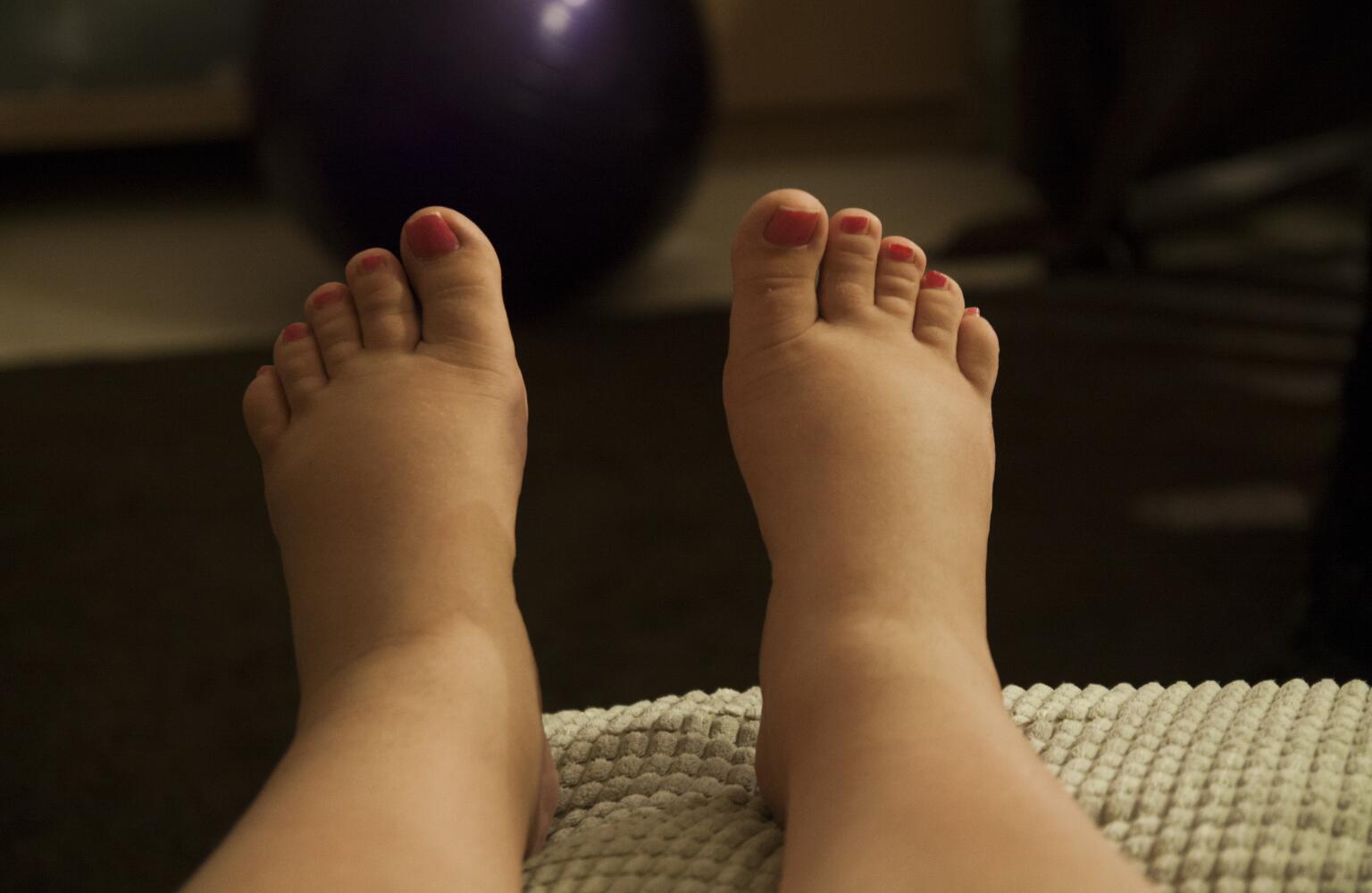 When to See a Doctor for Swollen Feet Treatment