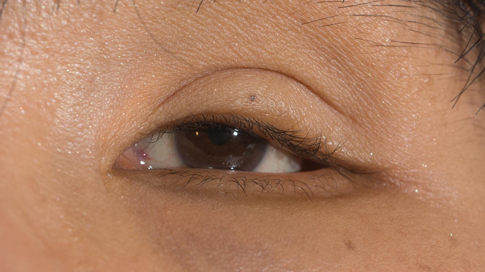 Sunken Eyes Causes, Appearance, Treatments, and More