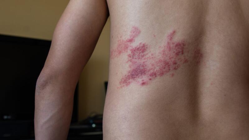 Shingles is a painful rash that affects one side of the body. It's caused by the varicella-zoster virus.