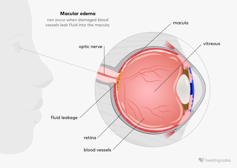 An illustration of an eye showing damaged blood vessels leaking fluid into the macula.