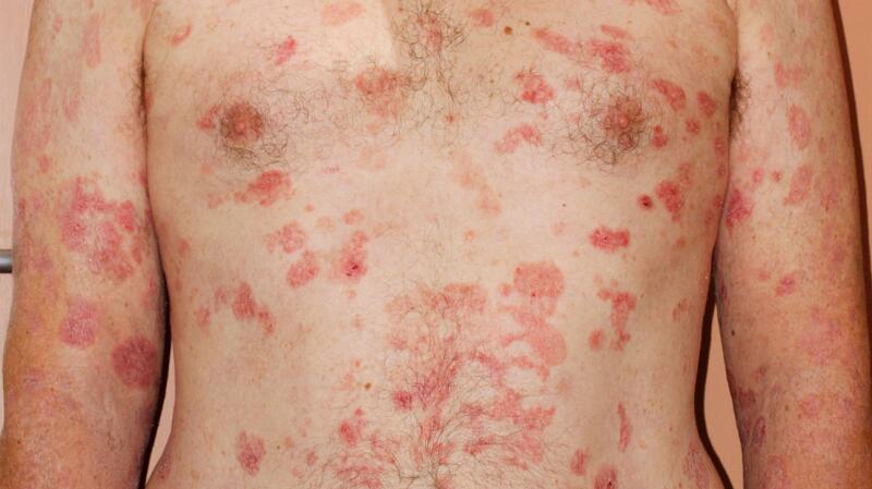 Cutaneous T-Cell Lymphoma: Symptoms, Causes, Treatments