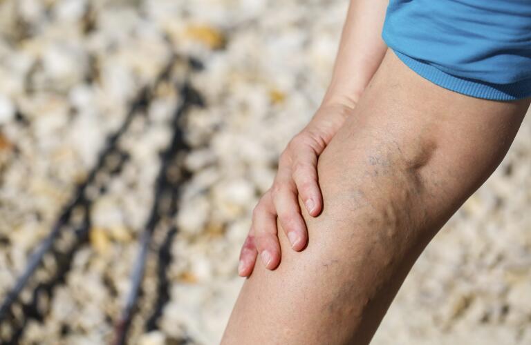 When to See a Doctor for Varicose Veins