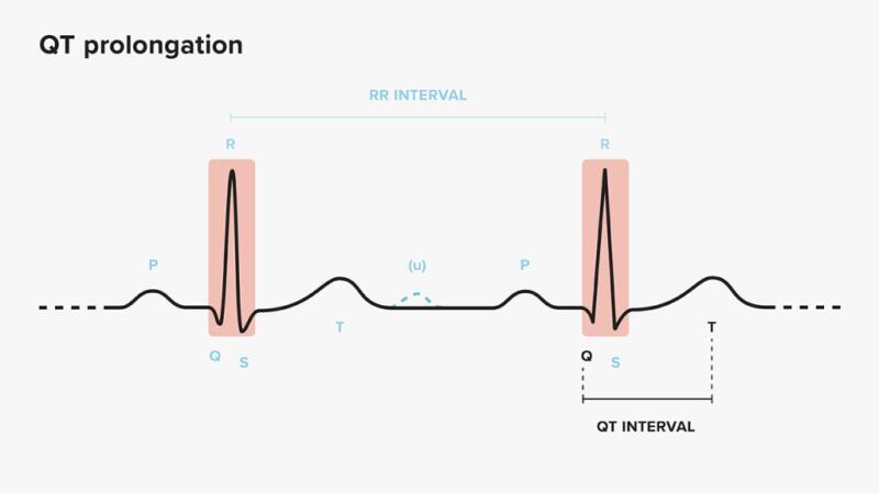 Illustration of heart beat QT interval