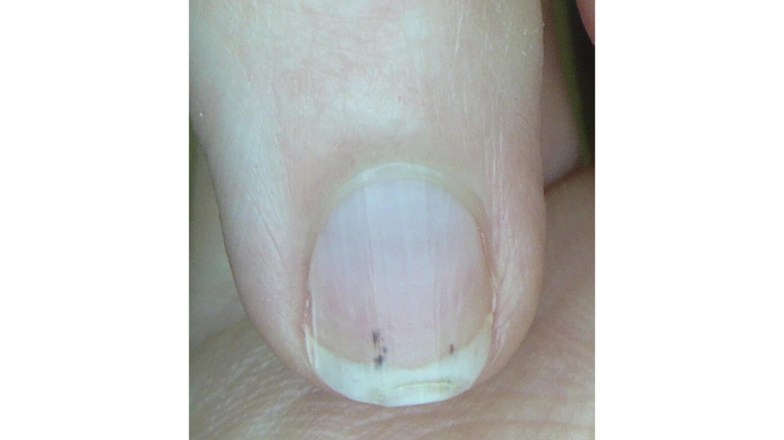 Splinter Hemorrhages Symptoms, Causes, Treatments