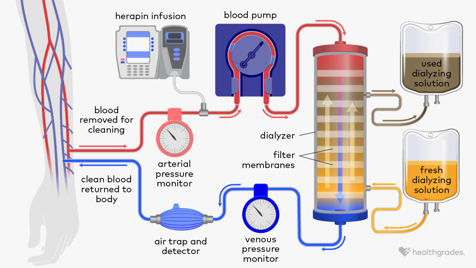 Hemodialysis vs. Peritoneal Dialysis: Differences Explained