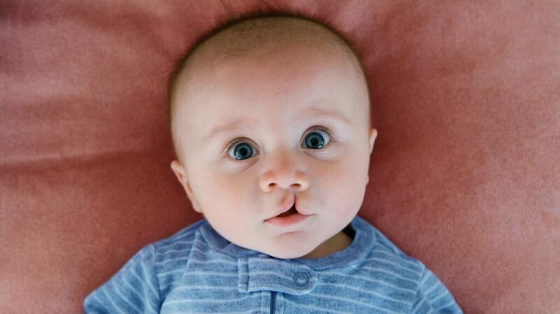 There is a baby with a cleft lip.