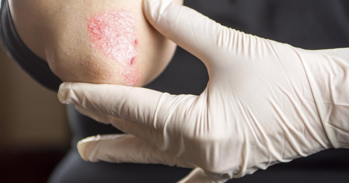 5 Signs of a Psoriasis Flare