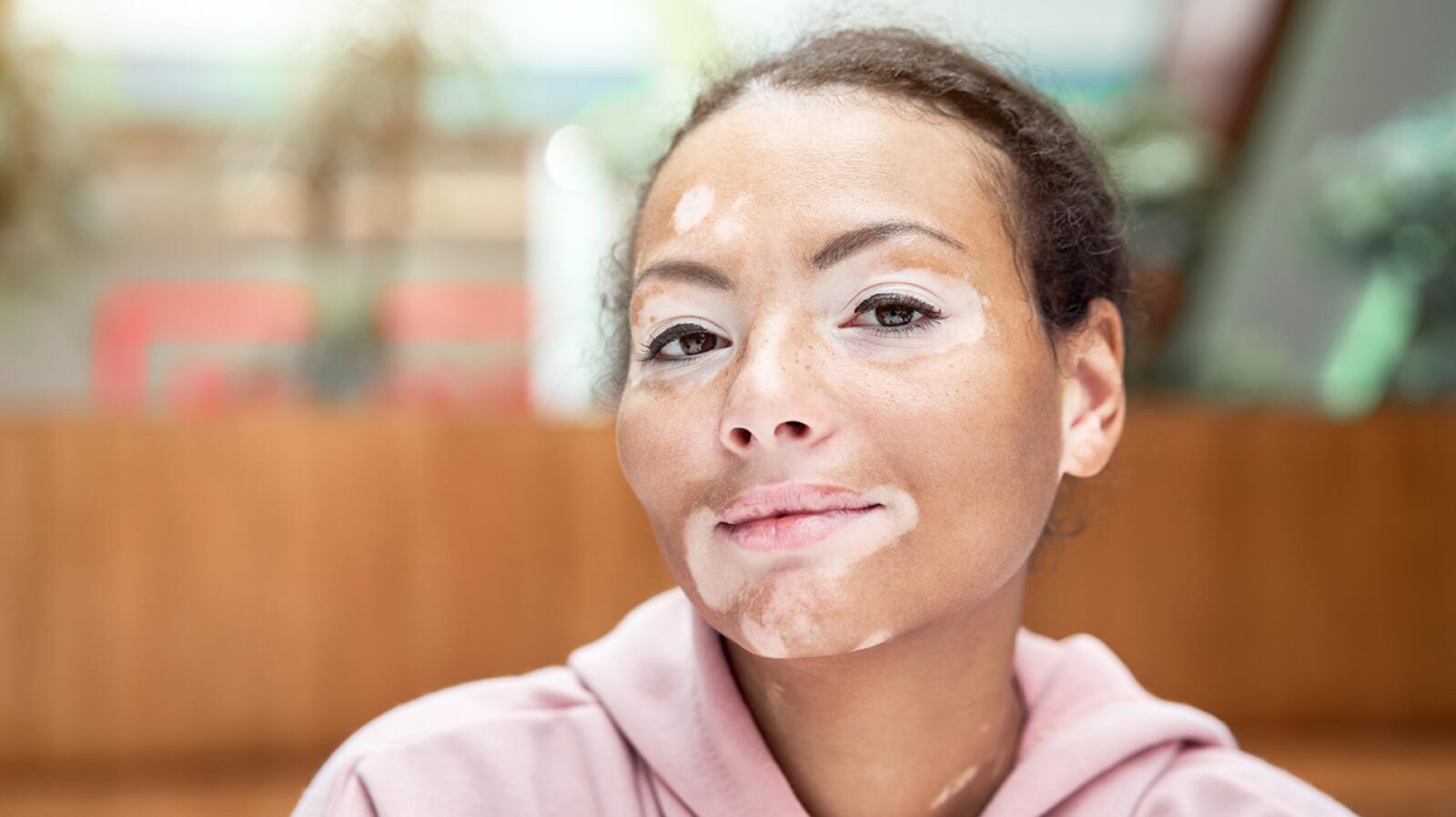 Tinea Versicolor: Symptoms, Causes, and Treatment