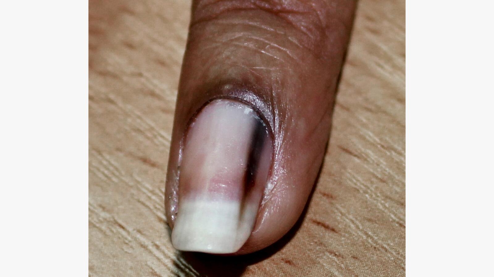 Melanonychia Pictures, Types, Symptoms, Causes, and More