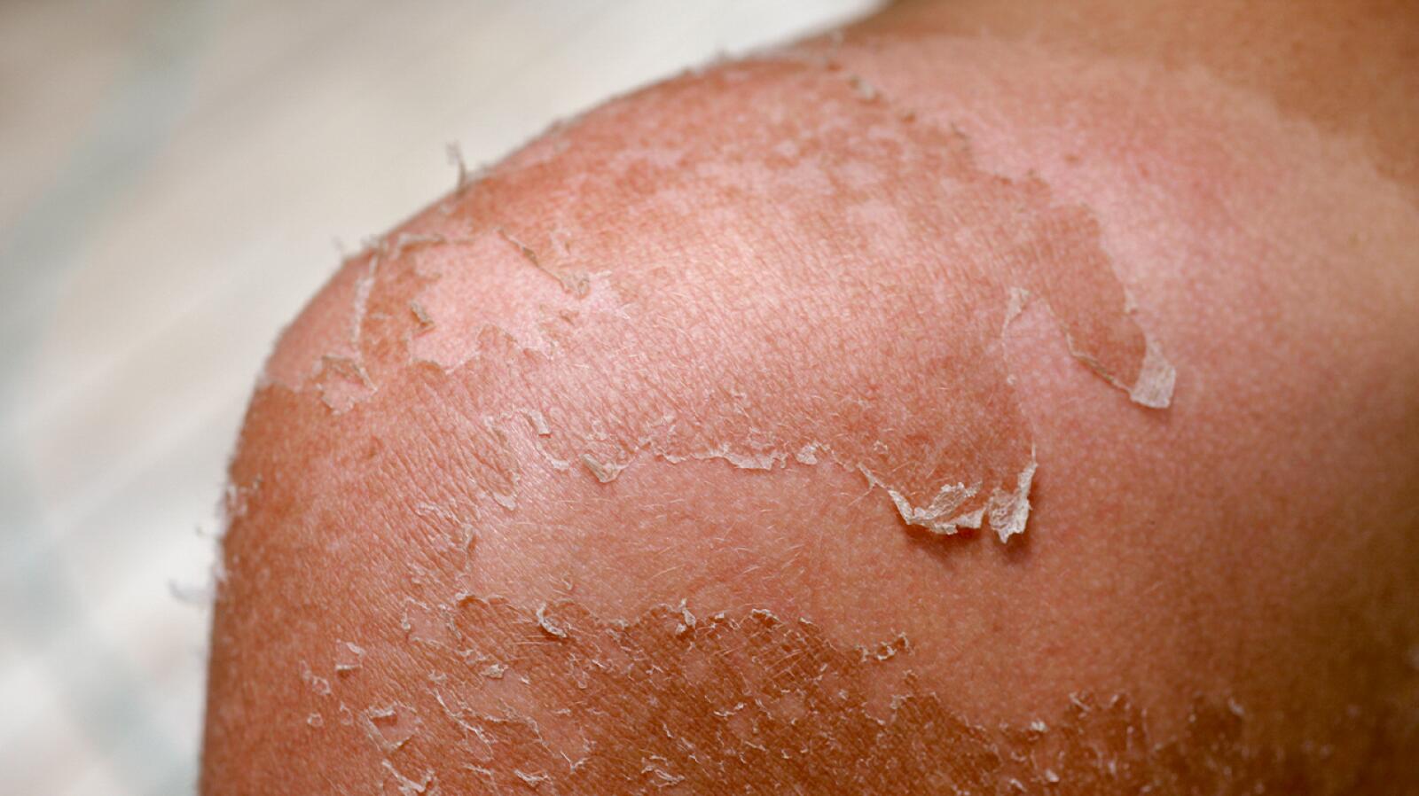 Sun Poisoning Symptoms, Causes, Treatment, and More