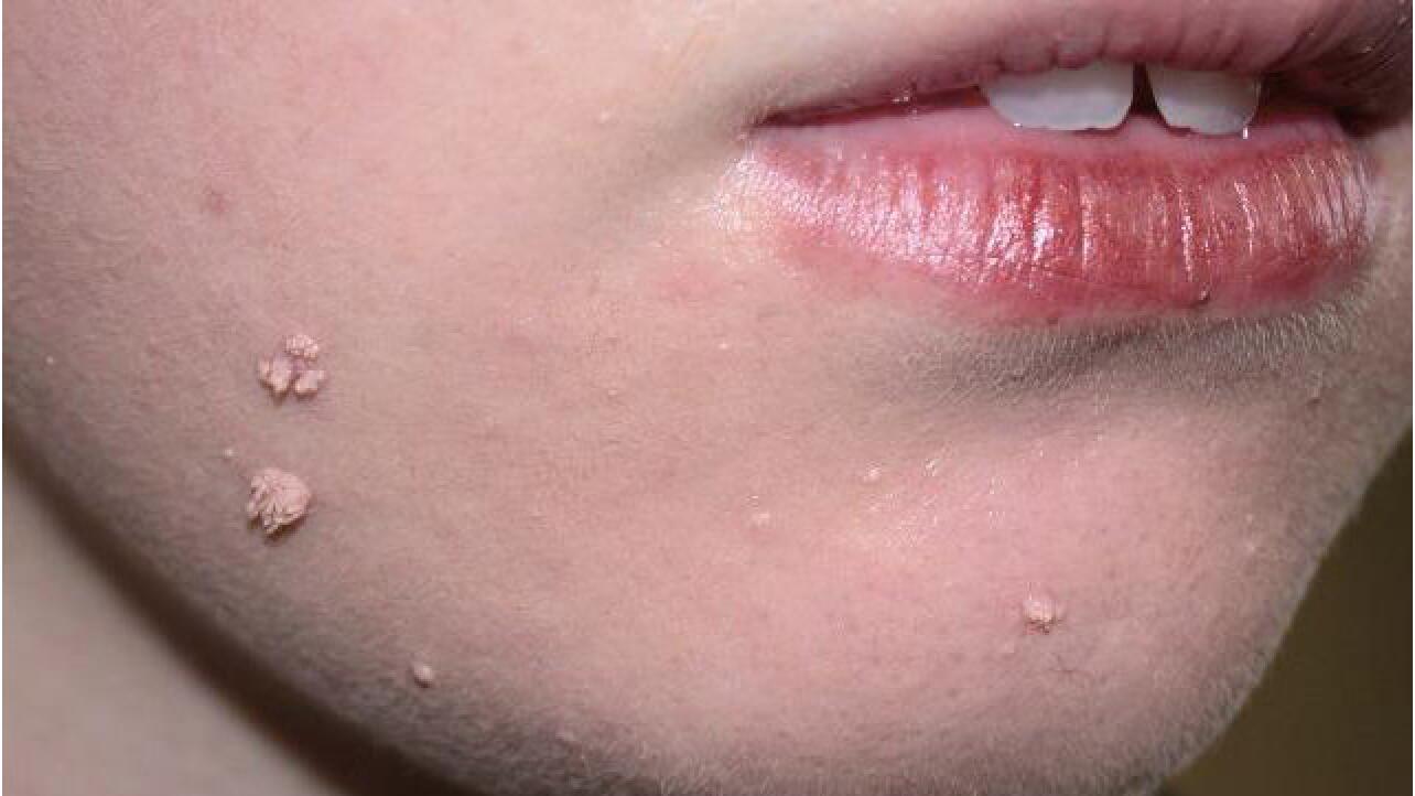 Filiform Wart Pictures Symptoms Causes Treatments