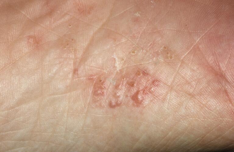pustular psoriasis on sole of man's foot