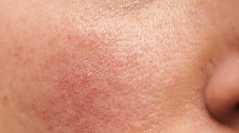 rosacea on woman's face