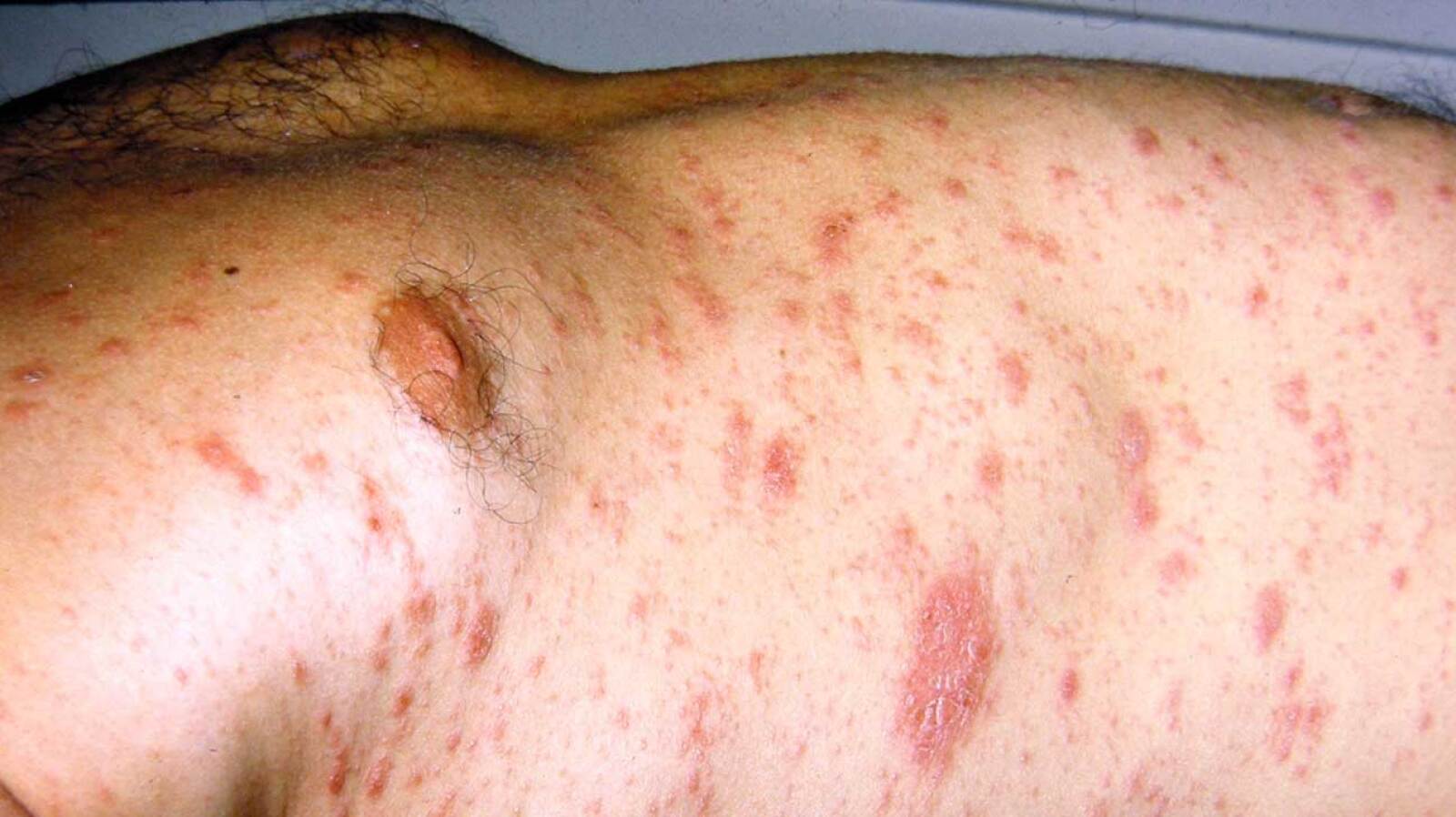 Circular Rash Back Rash on Back: Causes Treatments, Symptoms, and More