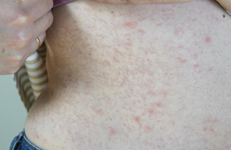 a red rash due to an allergic reaction on female stomach 