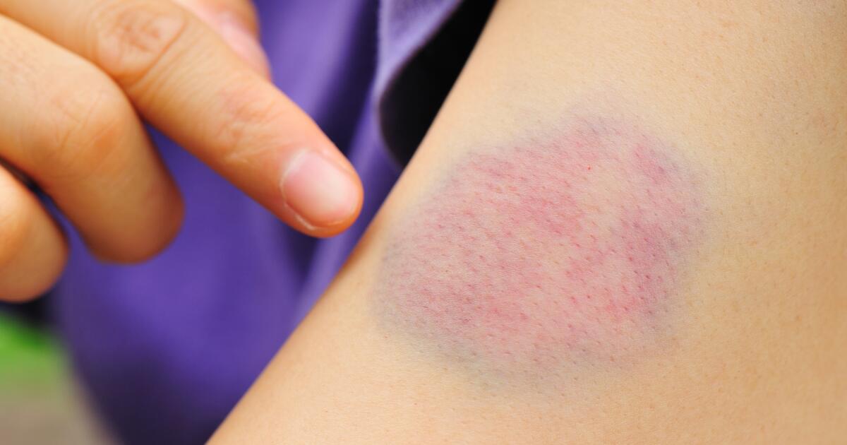 Contisions Muscle Contusion: Symptoms, Causes & Treatment | Muscle Bruises