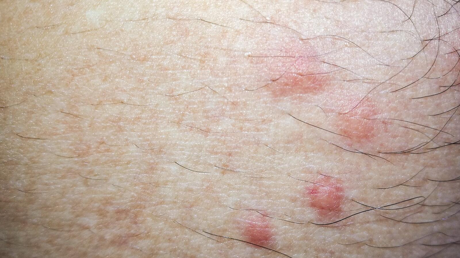 flea bites on humans pictures