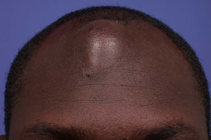 What Is Pus Causes Treatment And More Explained What Is Pus Causes Treatment And More Explained